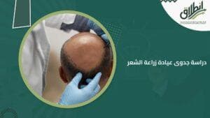 دراسة جدوى عيادة زراعة الشعر